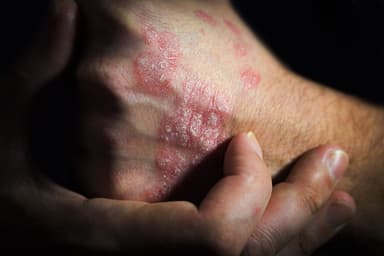 psoriasis | Image credit: SergeVo - stock.adobe.com