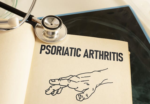 psoriatic arthritis | Image credit: Andrii - stock.adobe.com