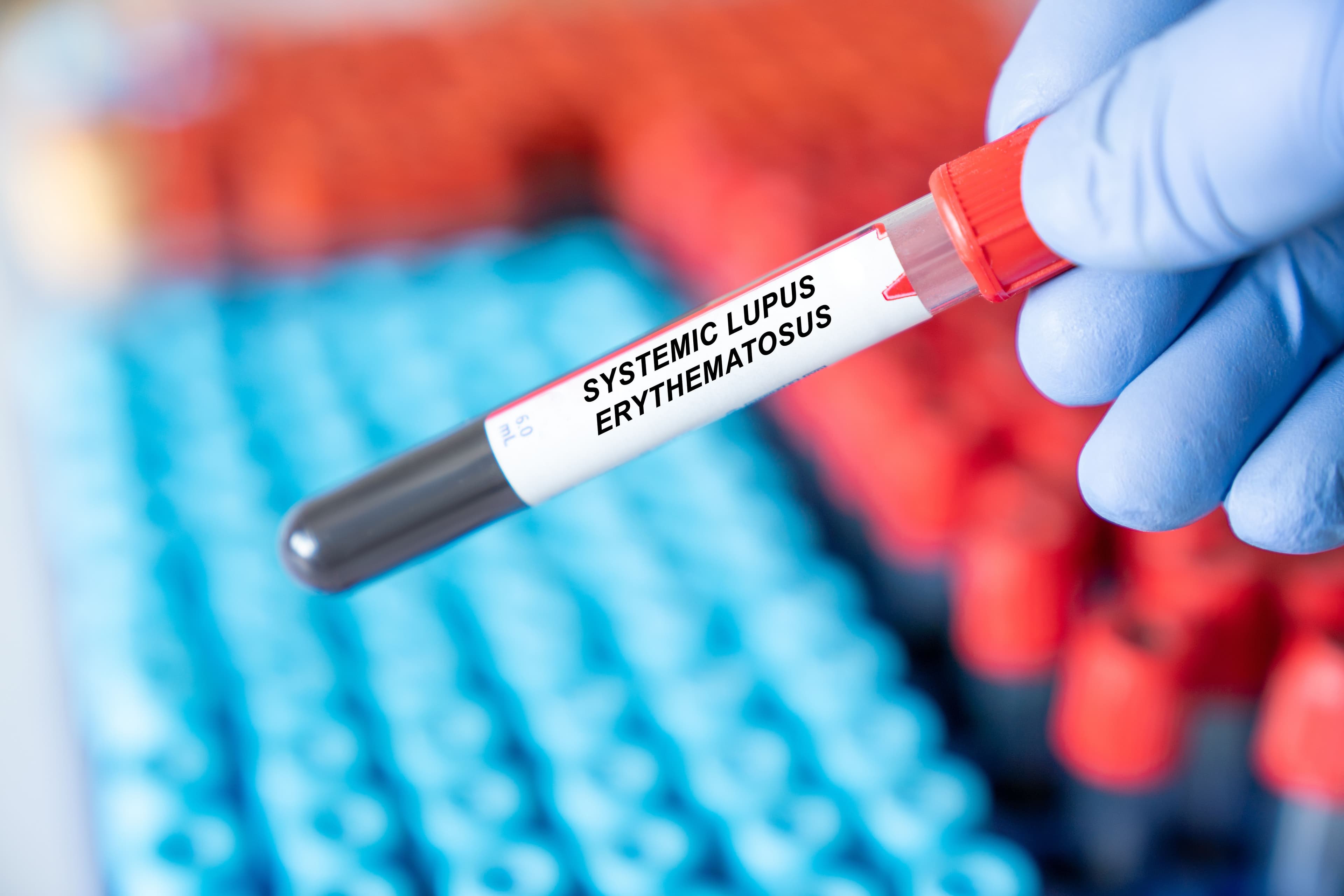 SLE bloodwork. | Image Credit:  luchschenF - stock.adobe.com